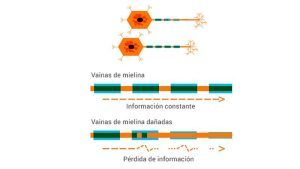 Esclerosis Múltiple